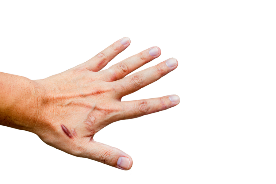 Can hypertrophic scars go away? Causes and treatment of hypertrophic