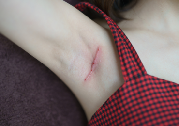 How to Get Rid of a Keloid Scar from Ingrown Hair