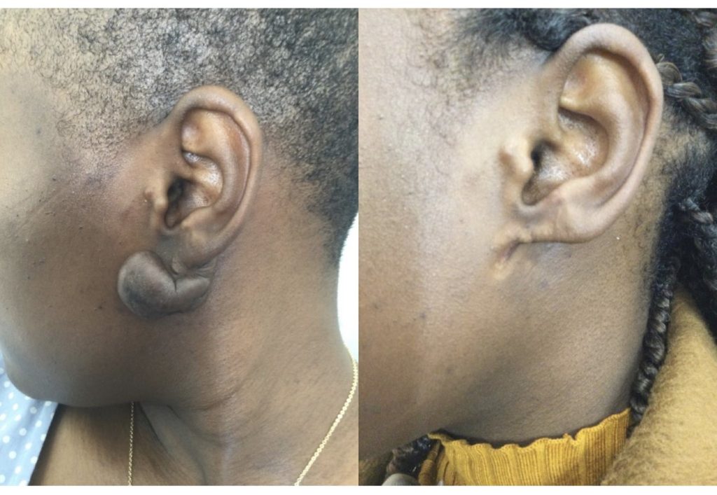 Ear keloid before and after treatment showing significant reduction.