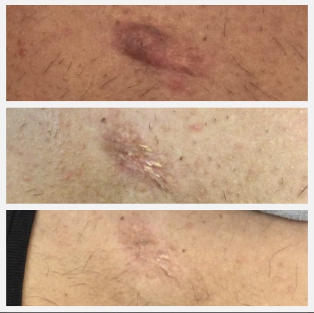 Before and after results of chest keloid therapy at the clinic.