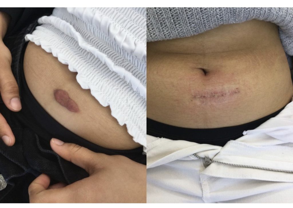 Belly keloid before and after treatment showing effective reduction.