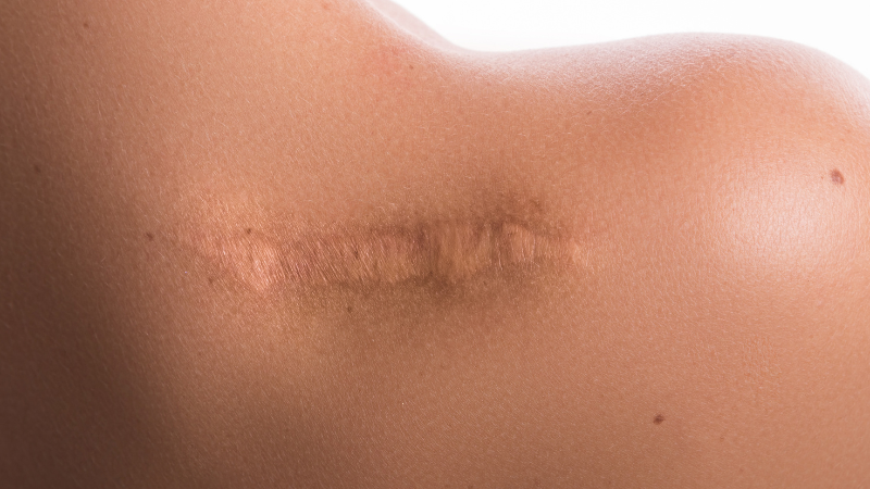 All Keloid Treatments