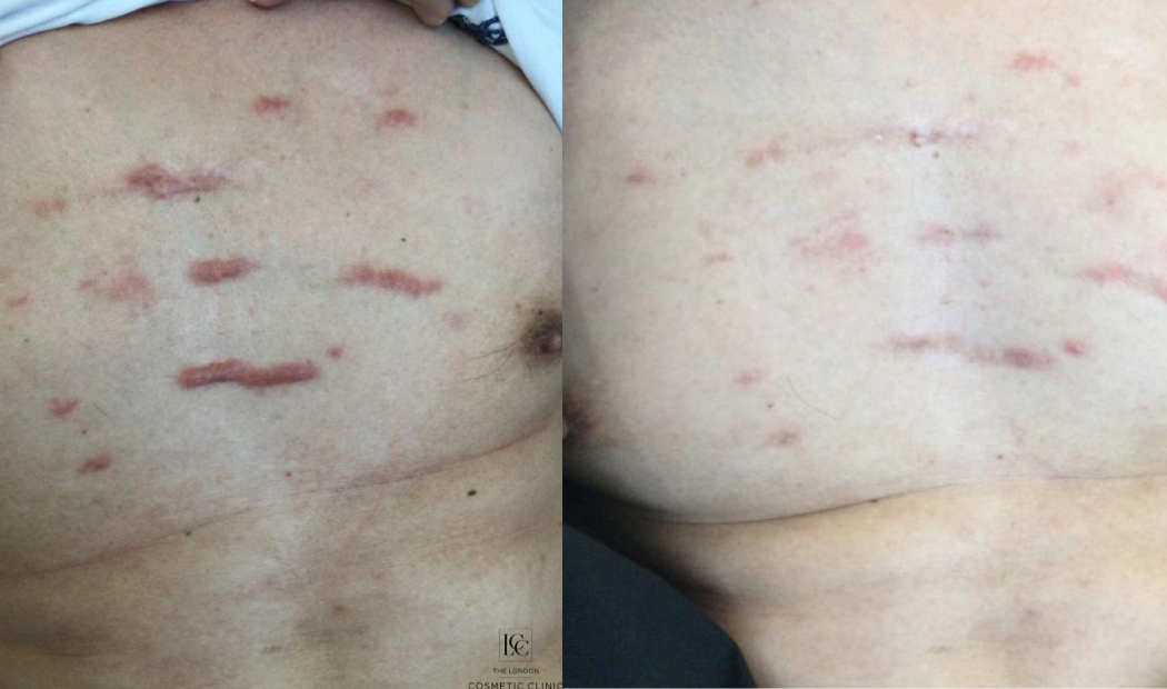 Keloid on chest before and after