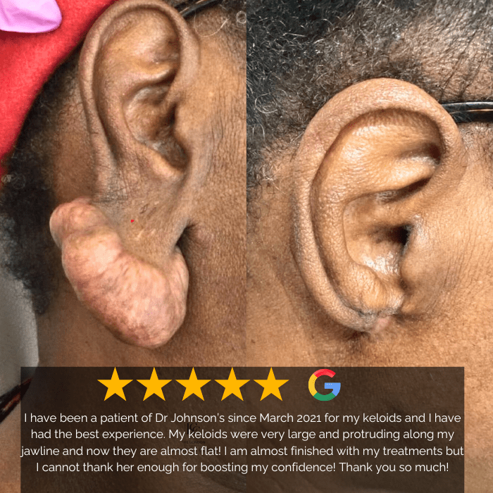 Keloid on ear before and after at our London Keloid |Scar Clinic