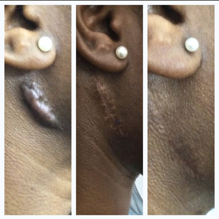 Keloid on neck before and after
