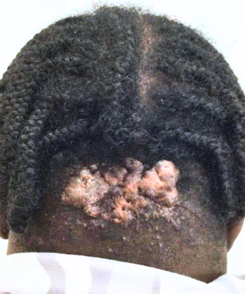 Image showing progress after the first treatment session for neck keloids.