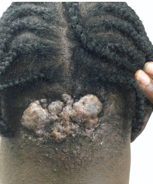 Close-up of a severe keloid on the back of the neck before treatment.