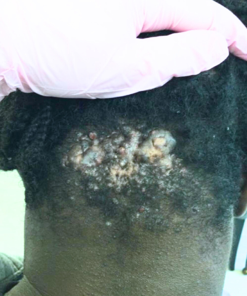 Mid-treatment photo showing reduced keloid size and improved skin texture.