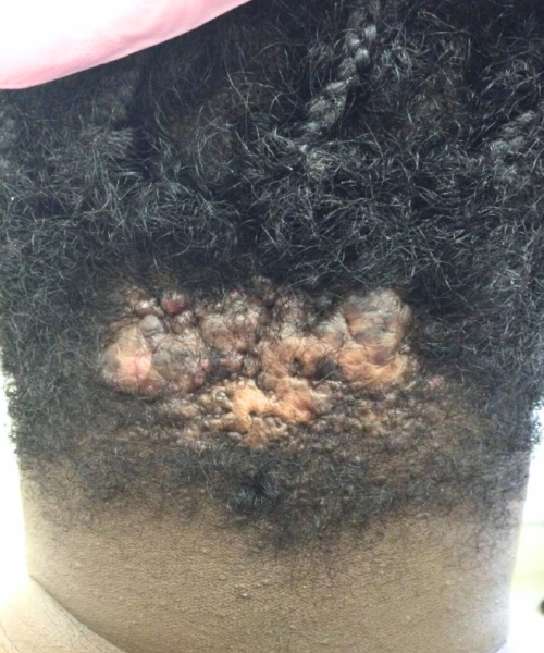 Progressive reduction in neck keloid size during the treatment process.