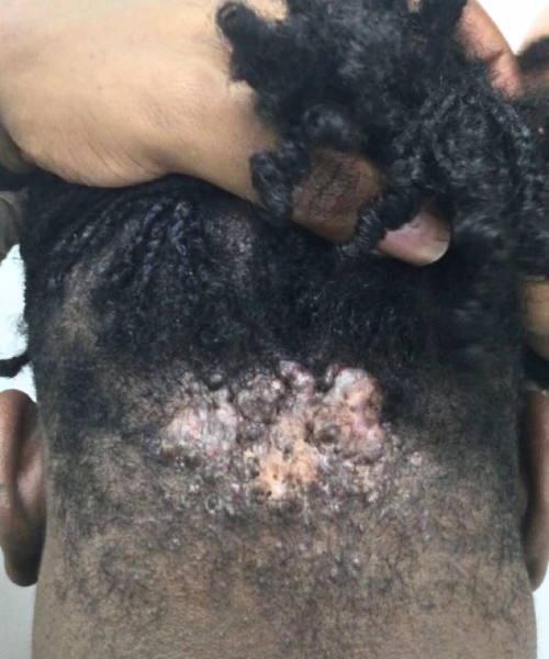 Image of advanced healing stages during keloid treatment on the neck.