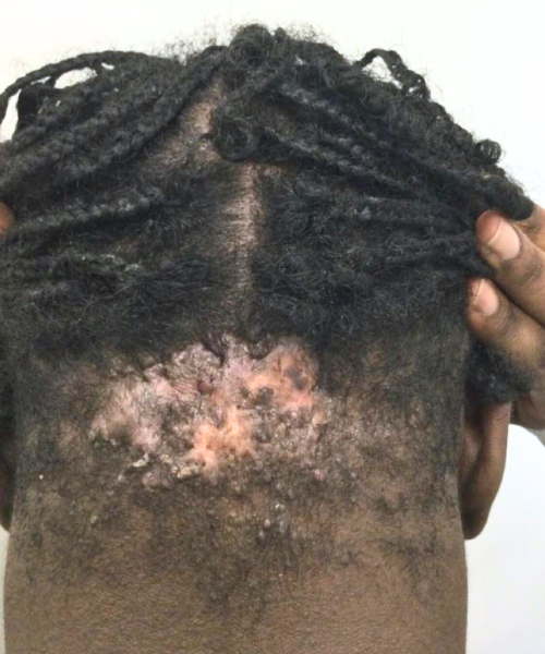 Photo showing near-final results of keloid treatment with flattened skin.