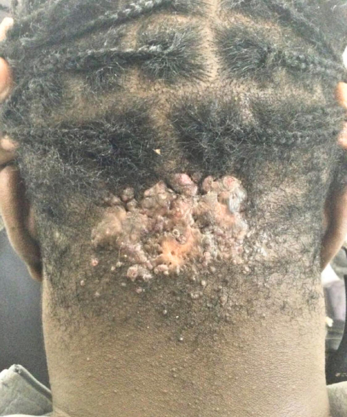 Image showing the results of keloid aftercare with healthy skin.