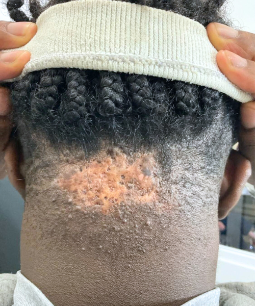 Photo showing ongoing keloid treatment focusing on stability and skin health.