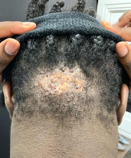 Image showing advanced keloid treatment results with noticeable improvement in skin texture.
