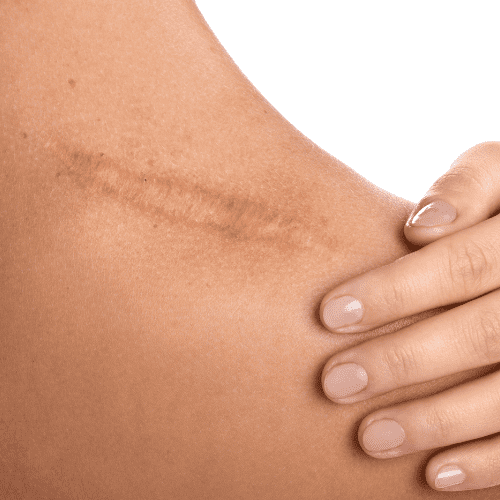 Scar Keloid