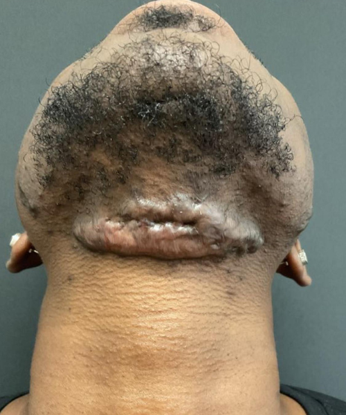 Keloid beginning
