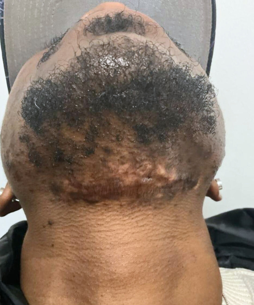Final result of keloid treatment on the neck, showing significantly flattened and smooth scar tissue with even skin tone.