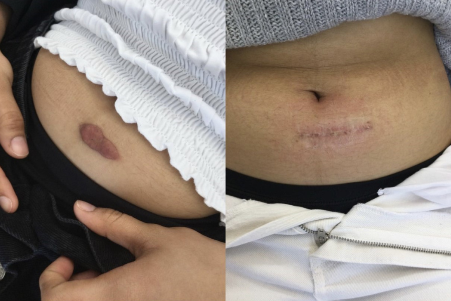 keloid scar on belly