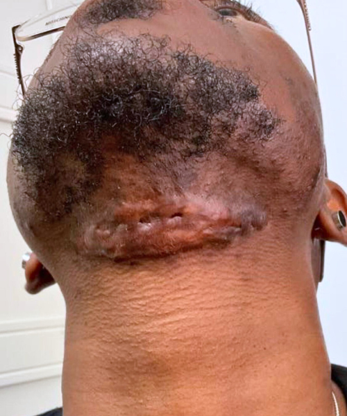 Neck keloid during the early stages of treatment, with reduced inflammation and visible redness indicating active healing.