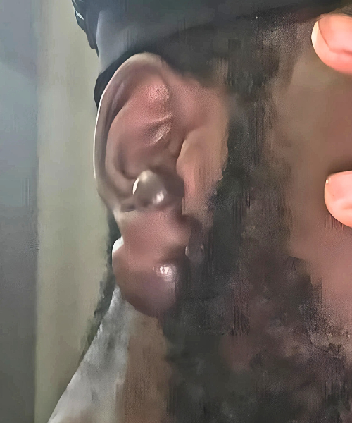Close-up of an ear with a large, raised keloid before treatment, showing thick scar tissue.