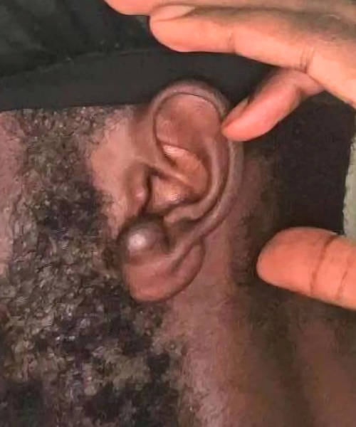 Close-up of an ear mid-treatment, showing a partially reduced keloid with some remaining raised tissue.