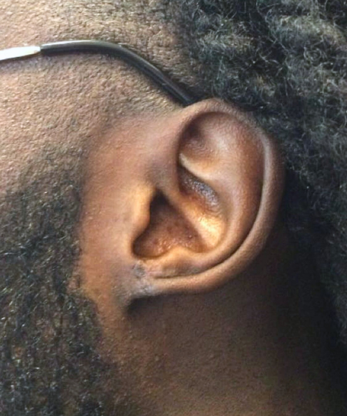 Close-up of an ear after keloid treatment, showing smooth, healed skin with restored natural contours.