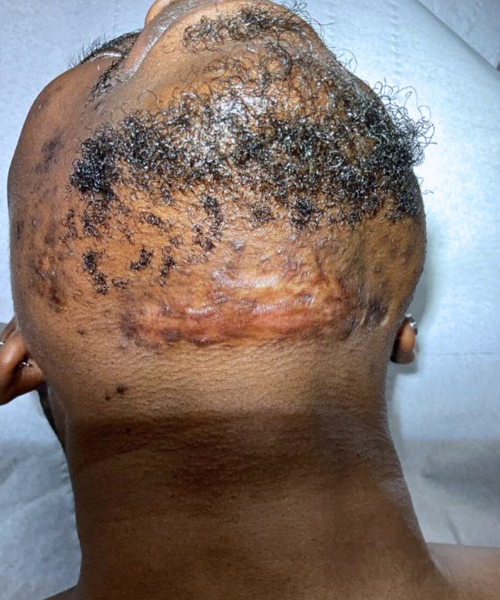 Mid-treatment progress of a neck keloid, showing flatter scar tissue and reduced pigmentation with smoother skin texture.