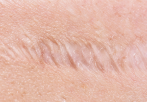Keloid Prevention: How We Help Stop Keloids from Coming Back