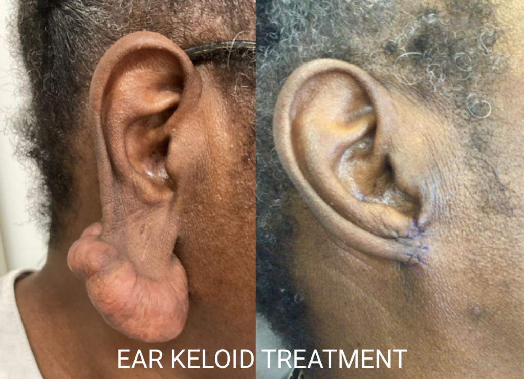 Ear Keloid Treatment: Specialised Approaches for Complex Cases