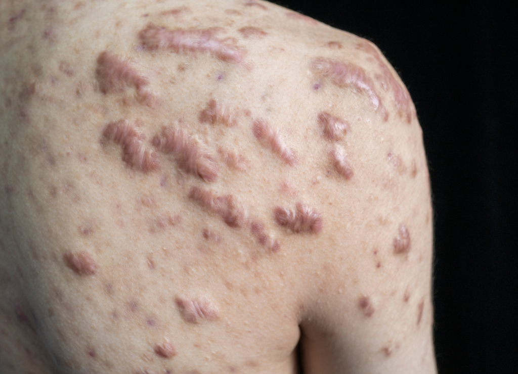 Keloid Monitoring: Recognising Changes and When to Seek Care