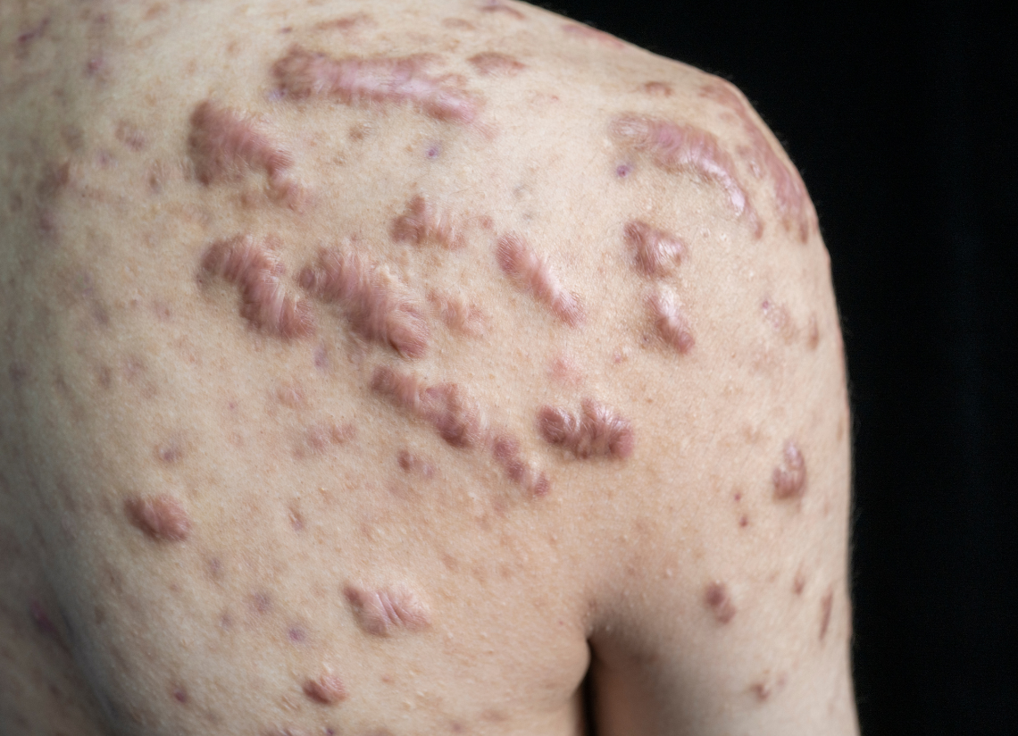 Keloid Monitoring: Recognising Changes and When to Seek Care