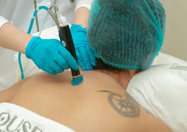 Laser Treatment for Keloid Scars Using VBeam Candela – London’s Most Advanced Solution