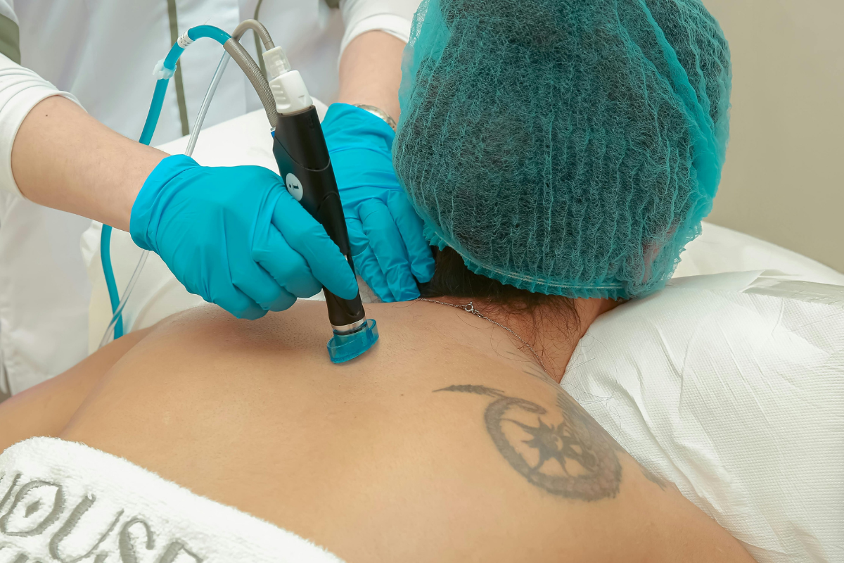 Laser Treatment for Keloid Scars Using VBeam Candela – London’s Most Advanced Solution