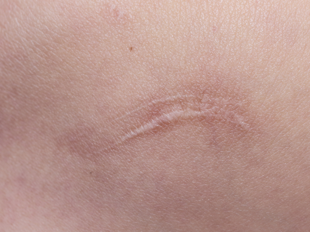 The Biology of Keloids: Why Some Scars Keep Growing