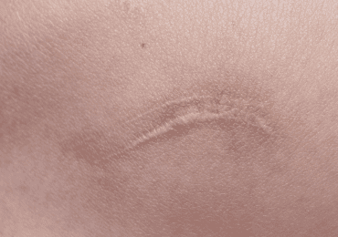 The Biology of Keloids: Why Some Scars Keep Growing