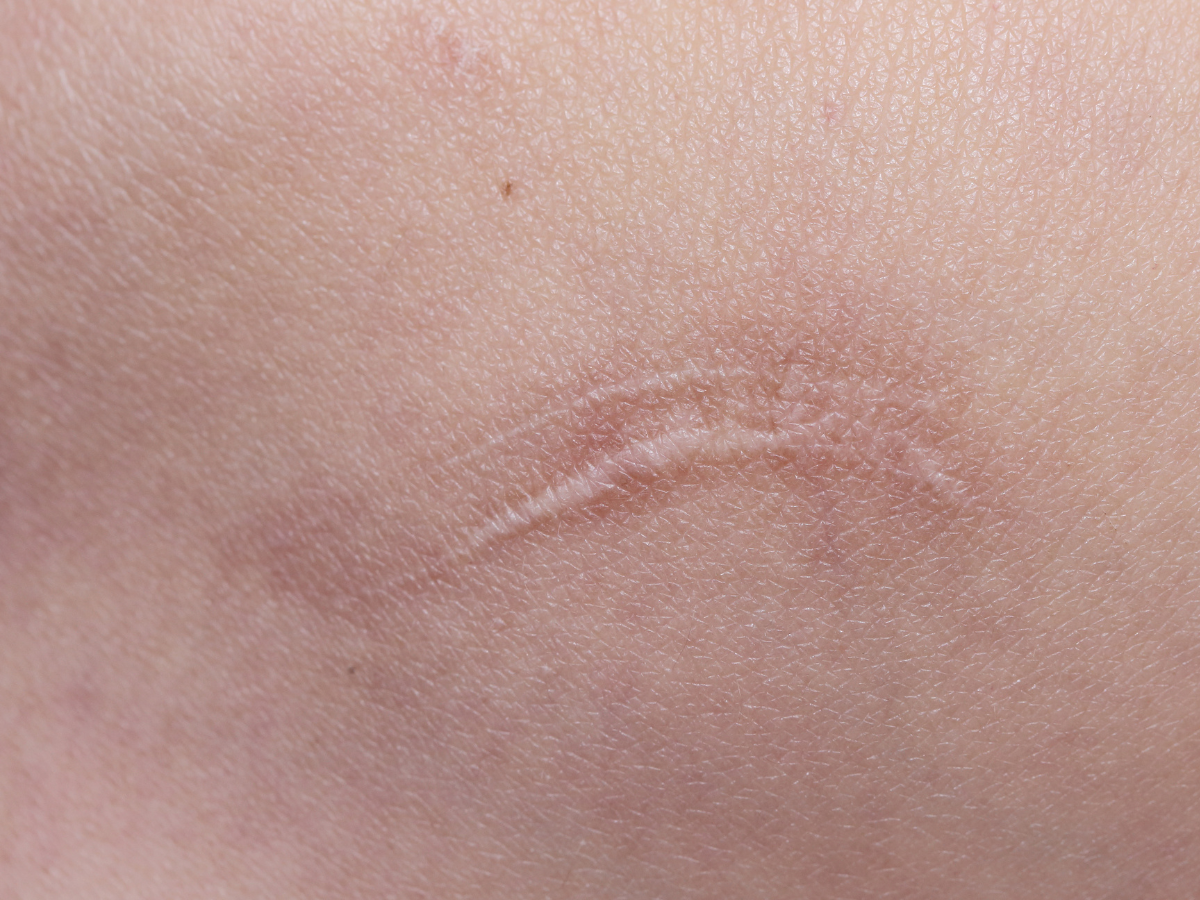 The Biology of Keloids: Why Some Scars Keep Growing