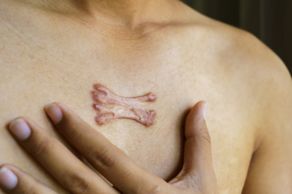 keloid-in-chest