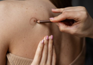 Non-Surgical Keloid Treatments in London | Injections & Laser Options