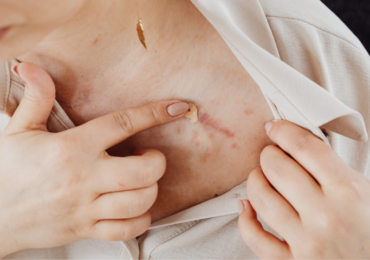 Keloids and Body Image: How Scar Treatment Supports Emotional Wellbeing