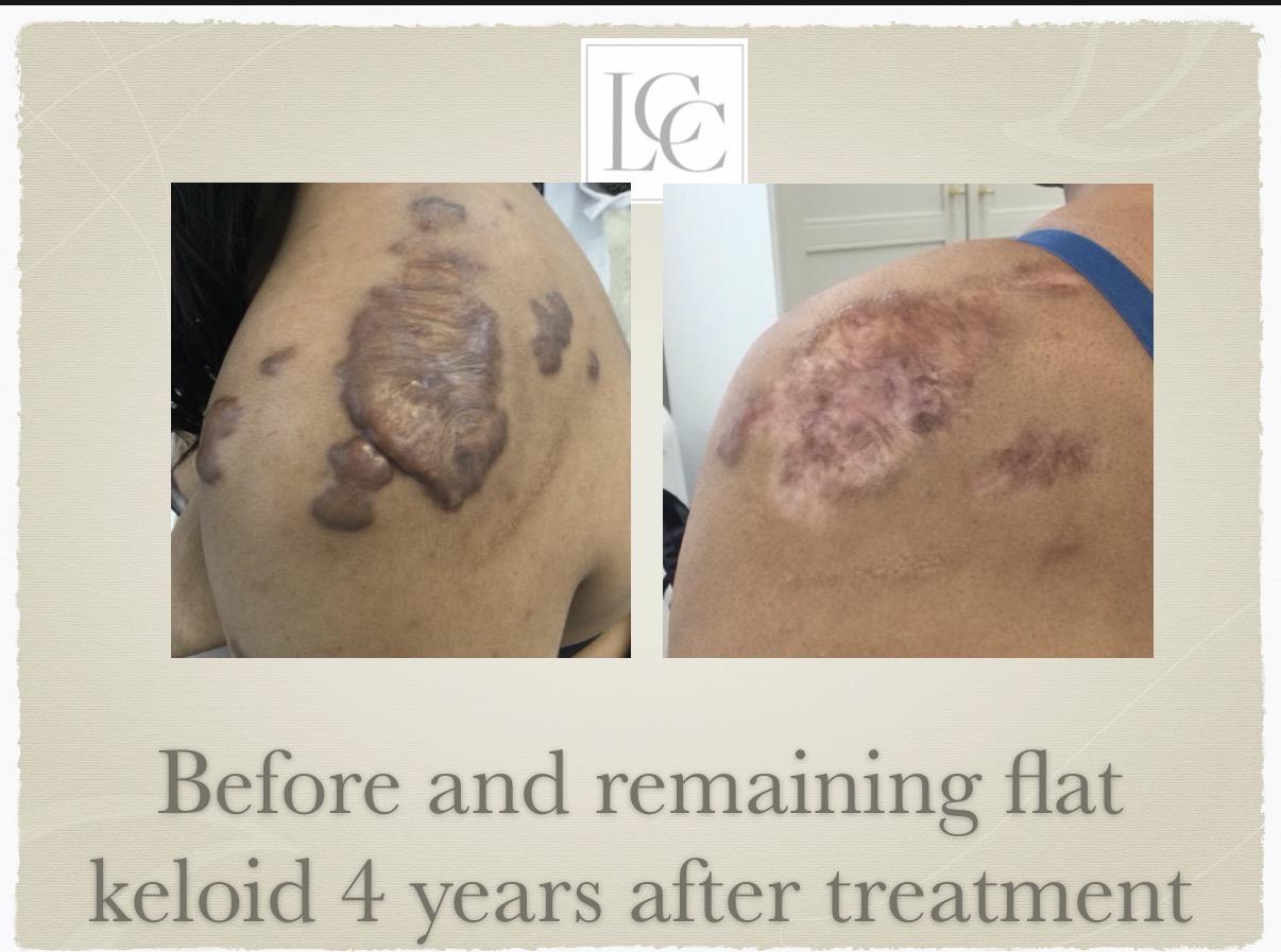 resistant-keloid-01