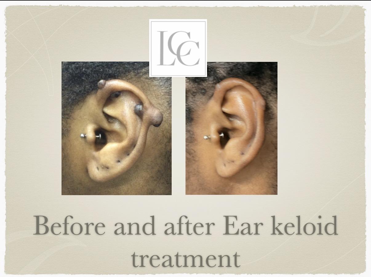 resistant-keloid-02