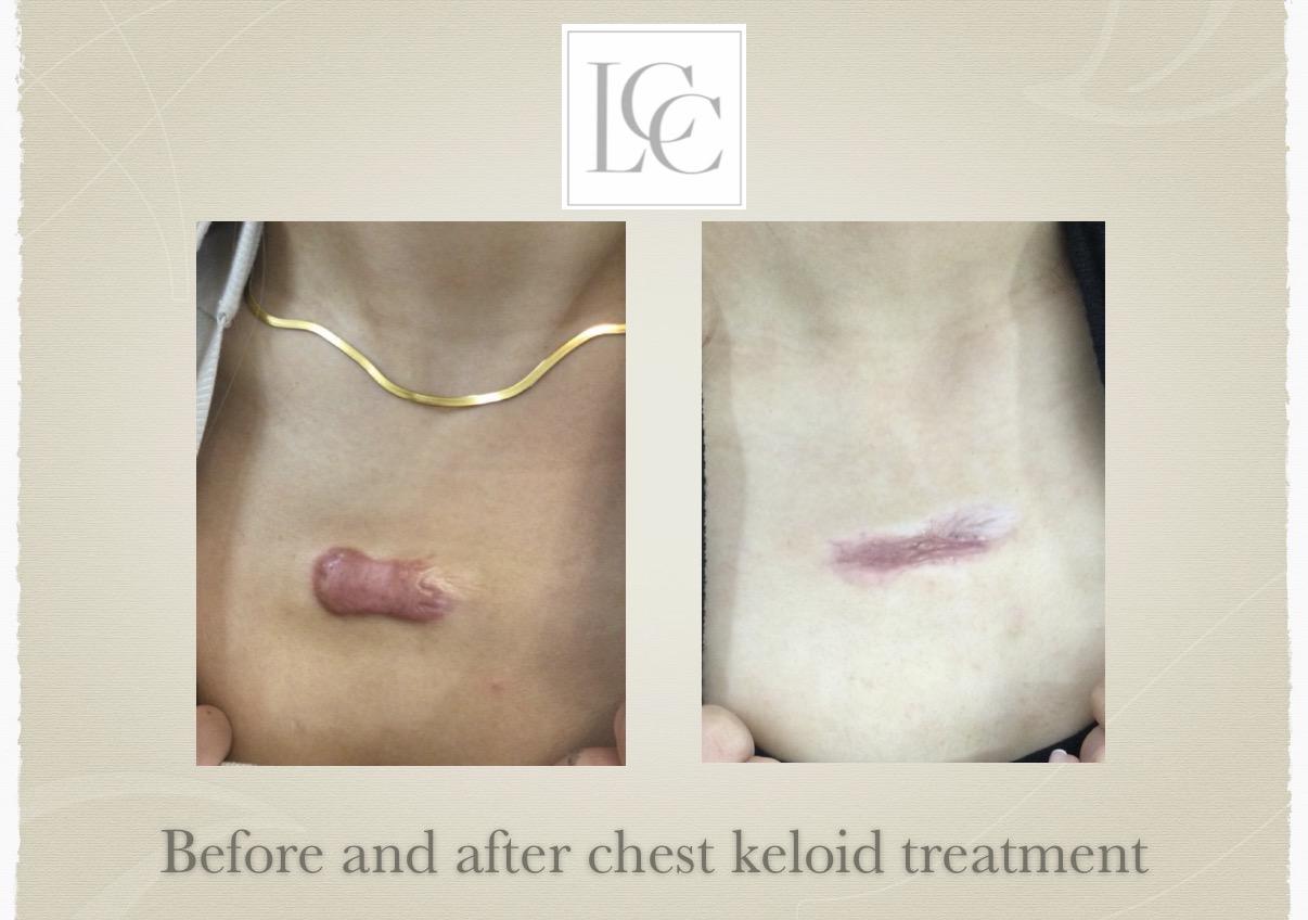 resistant-keloid-04